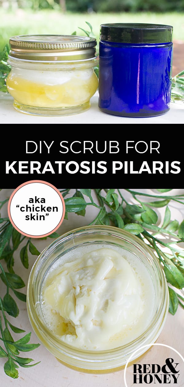 DIY Scrub and Lotion for Keratosis Pilaris (“Chicken Skin”) Red and Honey