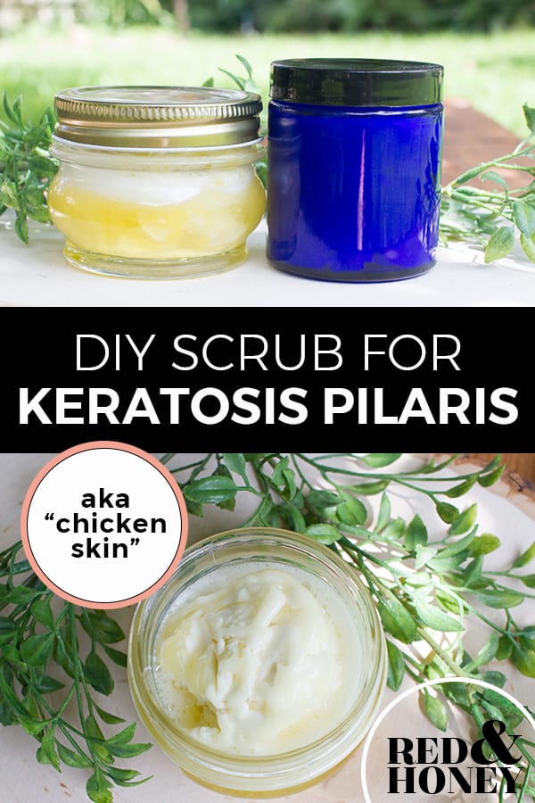 Pinterest pin with two images. Top image is of two jars of lotion sitting on a table outdoors. The second image is of an open jar filled with scrub. Text overlay says, "DIY Scrub for Keratosis Pilaris: aka 'chicken skin'."
