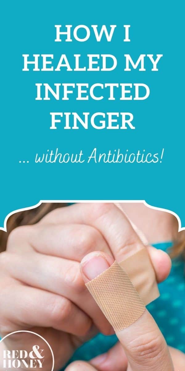 how-i-healed-my-infected-finger-without-antibiotics-red-and-honey