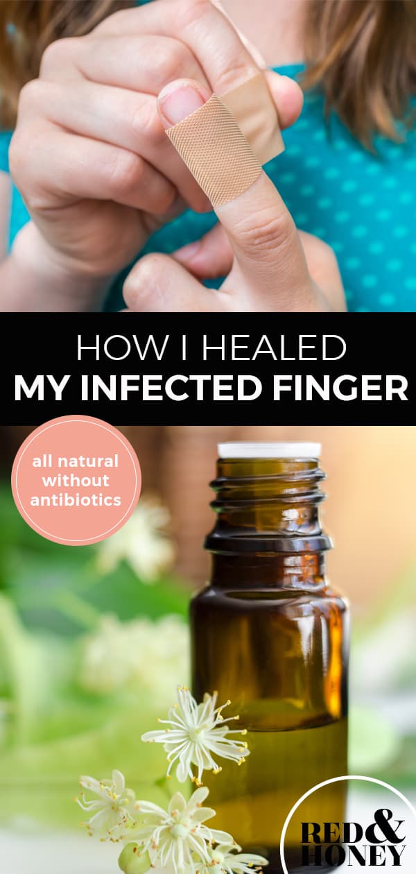 RedandHoney_Pin_Howhealedmyinfectedfinger_600x1260 Red and Honey