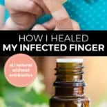 Pinterest pin with two images. The first image is of a woman putting a bandaid on her finger. The second image is of a bottle of essential oil sitting on a counter with herbs. Text overlay says, "How I healed my infected finger: all natural without antibiotics".