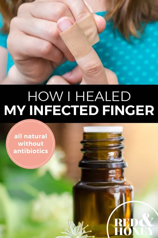 Pinterest pin with two images. The first image is of a woman putting a bandaid on her finger. The second image is of a bottle of essential oil sitting on a counter with herbs. Text overlay says, "How I healed my infected finger: all natural without antibiotics".