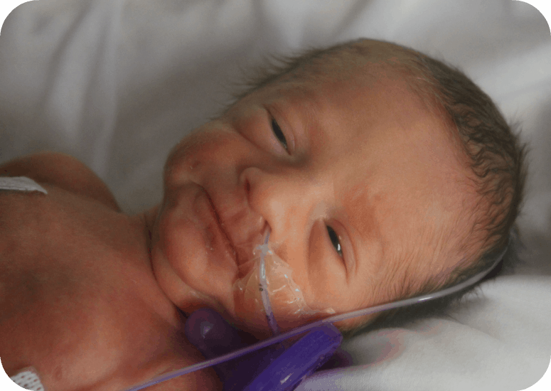 Image is of a tiny NICU baby with a nasal feeding tube.