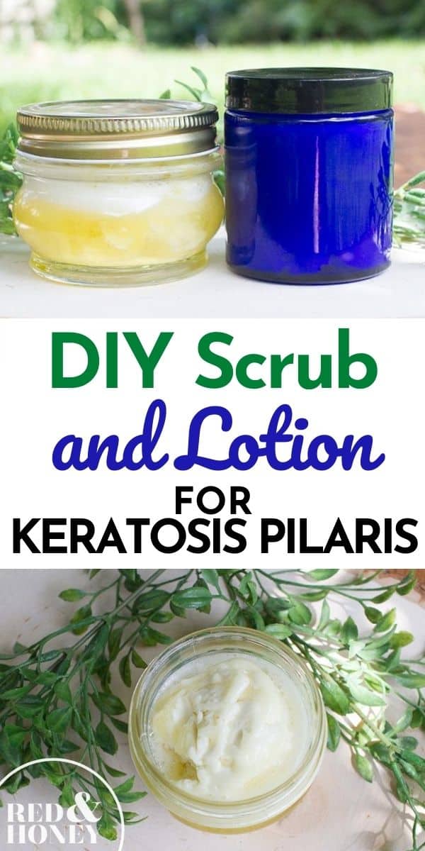 DIY Scrub and Lotion for Keratosis Pilaris (“Chicken Skin”) - Red and Honey