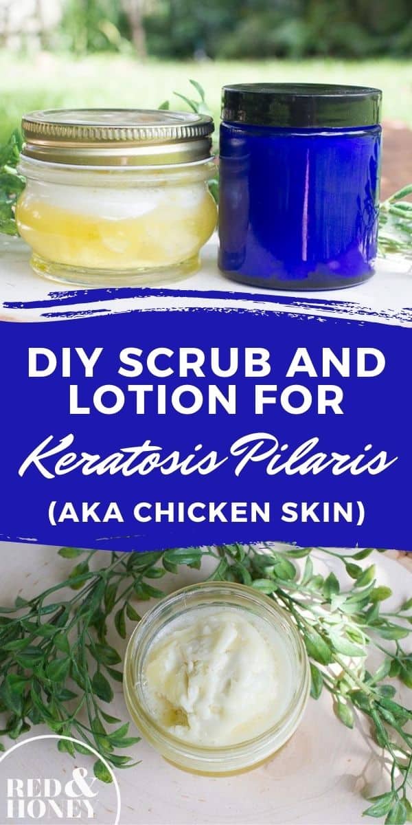 DIY Scrub and Lotion for Keratosis Pilaris (“Chicken Skin”) Red and Honey