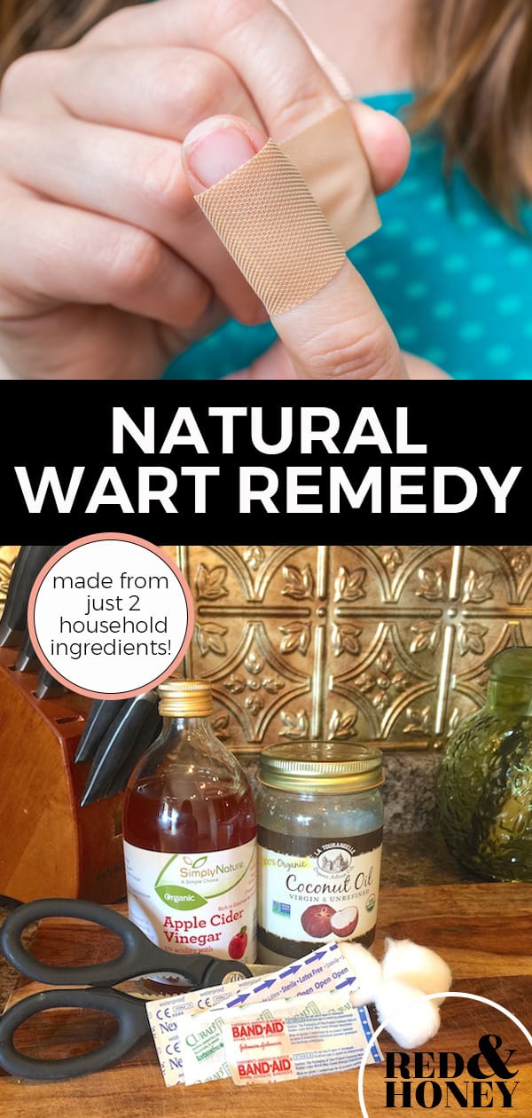How to Use Apple Cider Vinegar for Warts (Effective Home Remedy)