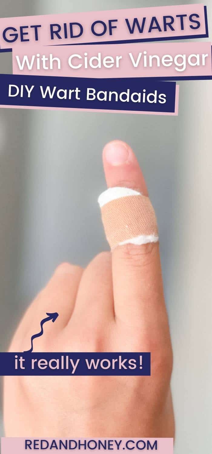 How to Use Apple Cider Vinegar for Warts (Effective Home Remedy)